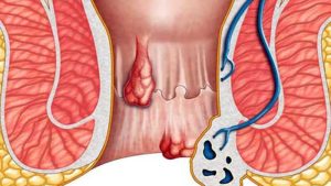 ঘরোয়া উপায়ে পাইলস থেকে মুক্তি