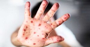 হাম ও উপসর্গে আরও ৭ জনের মৃত্যু