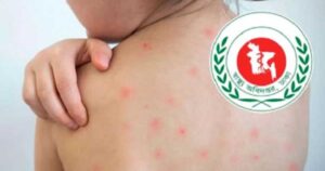 দেশে ২৪ ঘণ্টায় হাম ও উপসর্গে আরও ৮ শিশুর মৃত্যু